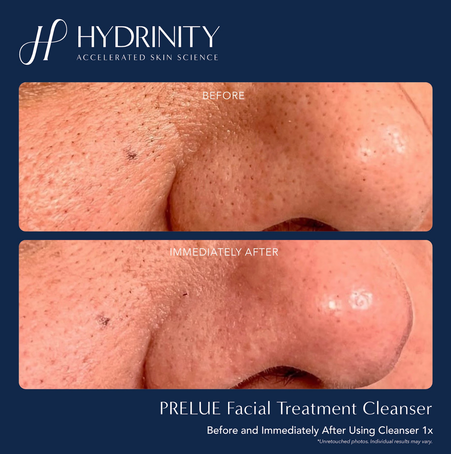 Prelude Facial Treatment Cleanser 6 fl oz