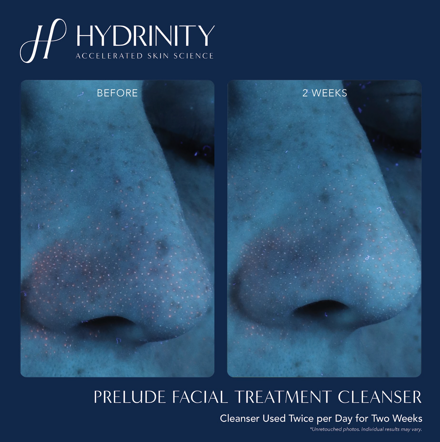 Prelude Facial Treatment Cleanser 6 fl oz