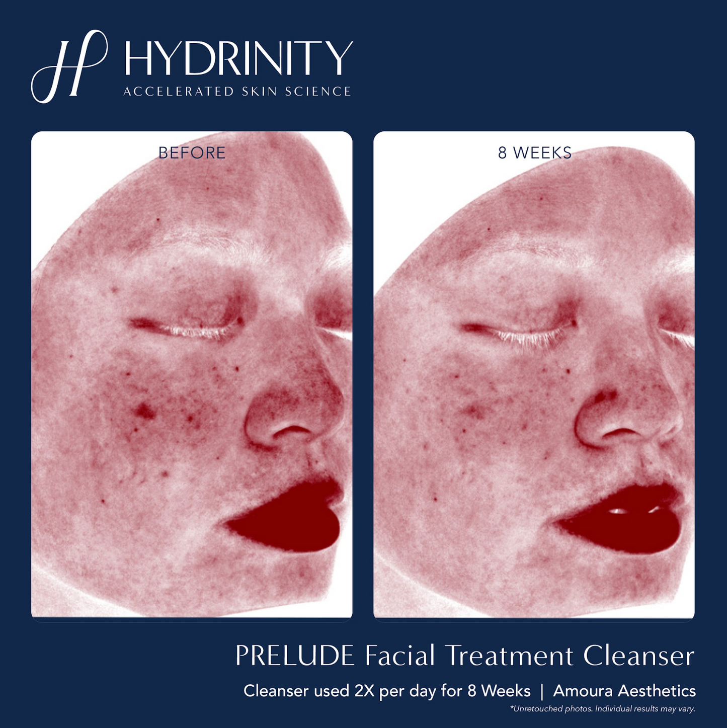 Prelude Facial Treatment Cleanser 6 fl oz