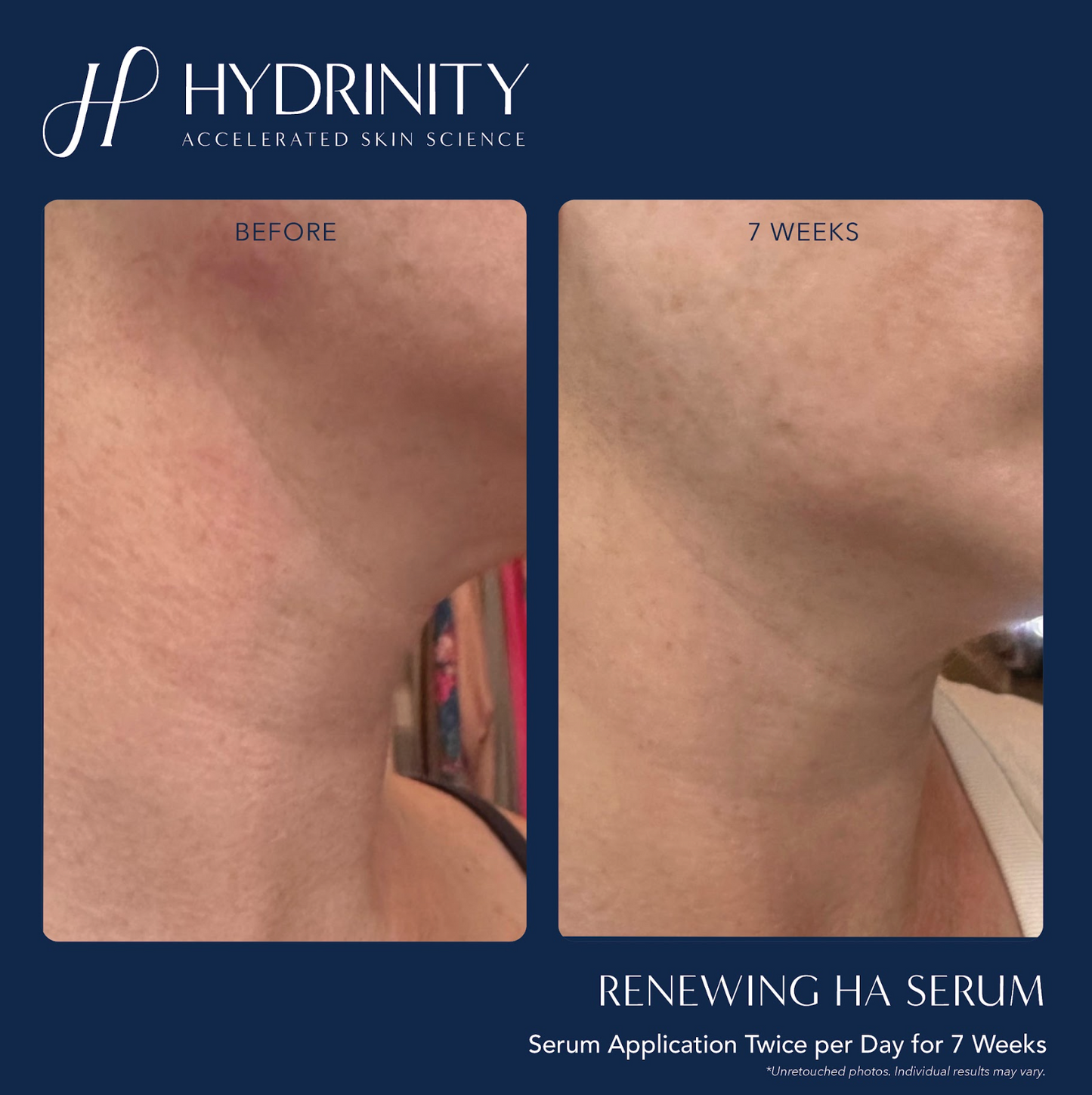 Renewing HA Serum