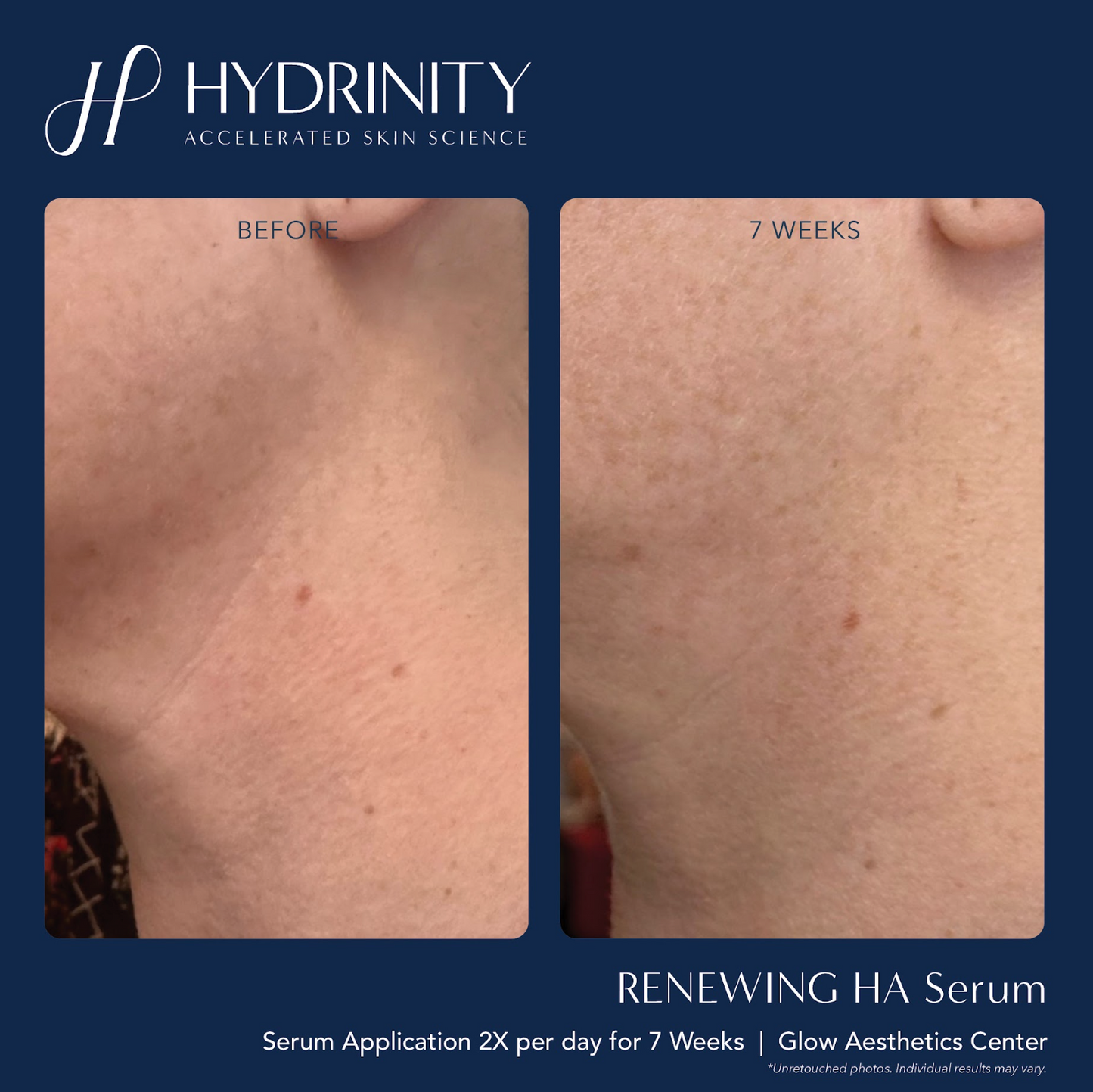 Renewing HA Serum